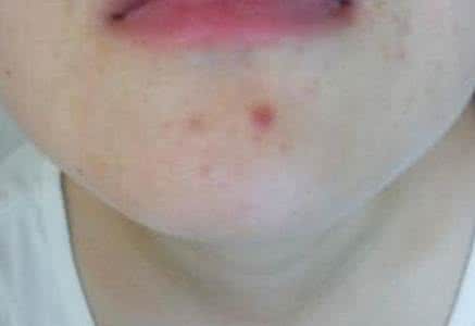 脸上长痘？不同部位有不同的破解法，看看你是哪种？