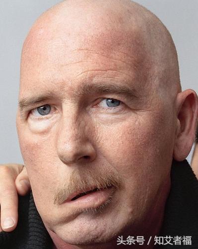 艾灸治疗面瘫效果好吗,艾灸治疗面瘫的偏方