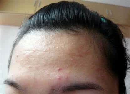 脸上长痘？不同部位有不同的破解法，看看你是哪种？