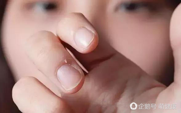 女生手有倒刺化脓,十岁女孩手上长满倒刺