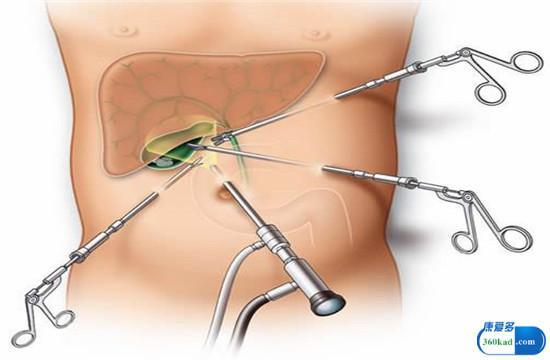 胆结石手术后需吃熊去胆酸胶囊吗,胆切除术后服熊去氧胆酸要服多久