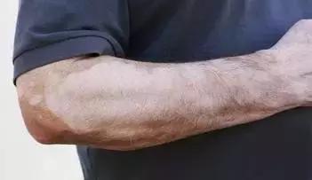 白癜风治疗要谨慎走入误区,白癜风自我诊断小妙招