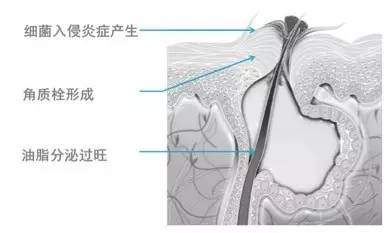 我的脸为什么老是这么油,我的脸很油怎么办
