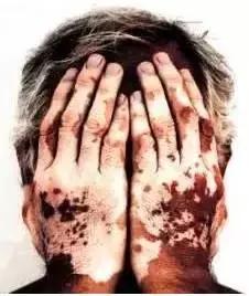 白癜风治疗要谨慎走入误区,白癜风自我诊断小妙招