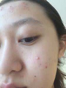 脸上长痘？不同部位有不同的破解法，看看你是哪种？