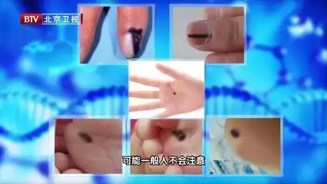 每个人都一定有痣吗,每一个痣都是代表疾病吗