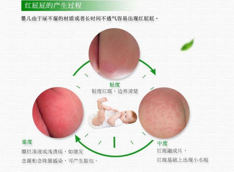 新手怎么护理宝宝红屁股,宝宝红屁股妈妈饮食关注