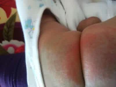 新手怎么护理宝宝红屁股,宝宝红屁股妈妈饮食关注