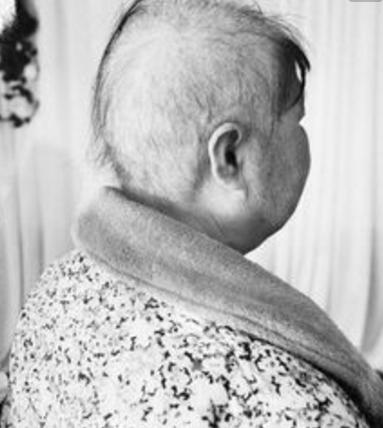 70岁老人癌症化疗8次了是什么情况,70岁老人化疗成功案例