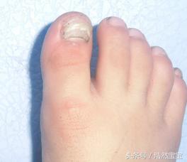 发现孩子指甲有问题日常建议,家长关注孩子手指甲
