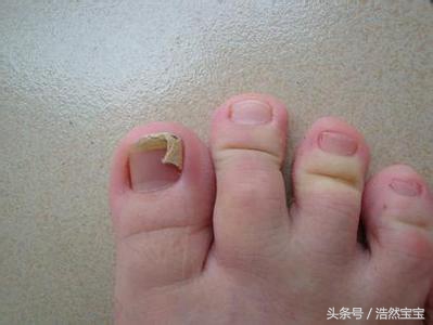 发现孩子指甲有问题日常建议,家长关注孩子手指甲