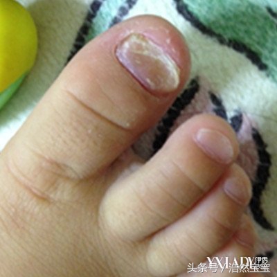 发现孩子指甲有问题日常建议,家长关注孩子手指甲