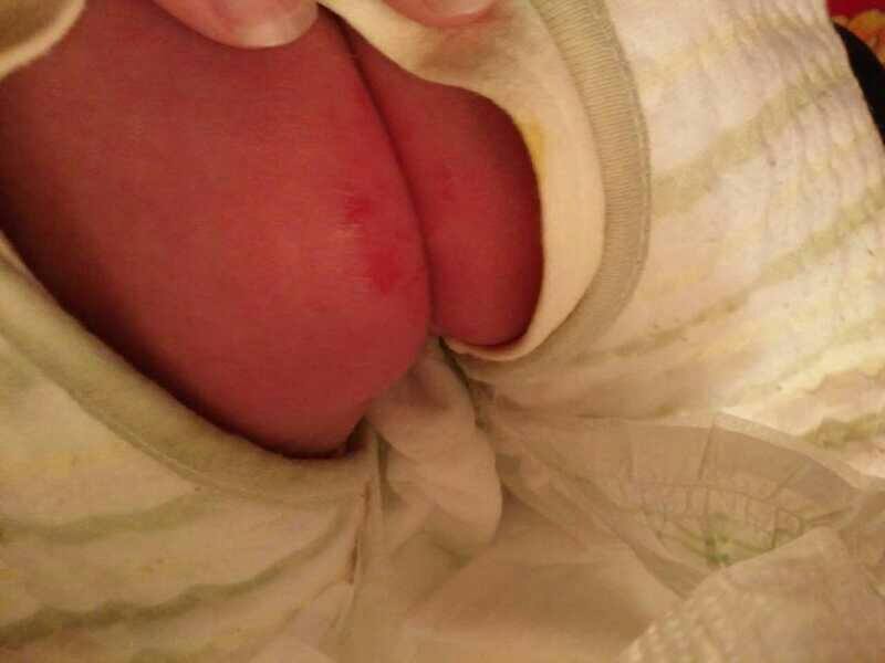 新手怎么护理宝宝红屁股,宝宝红屁股妈妈饮食关注