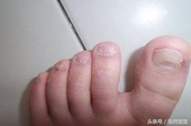 发现孩子指甲有问题日常建议,家长关注孩子手指甲