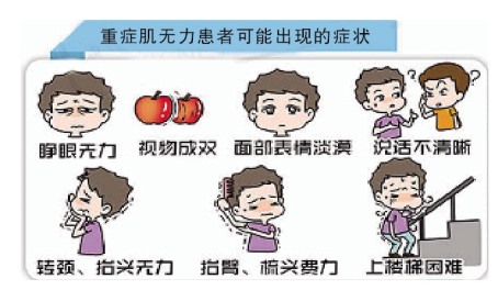 眼肌重症肌无力怎么治疗,重症肌无力治疗要多少钱