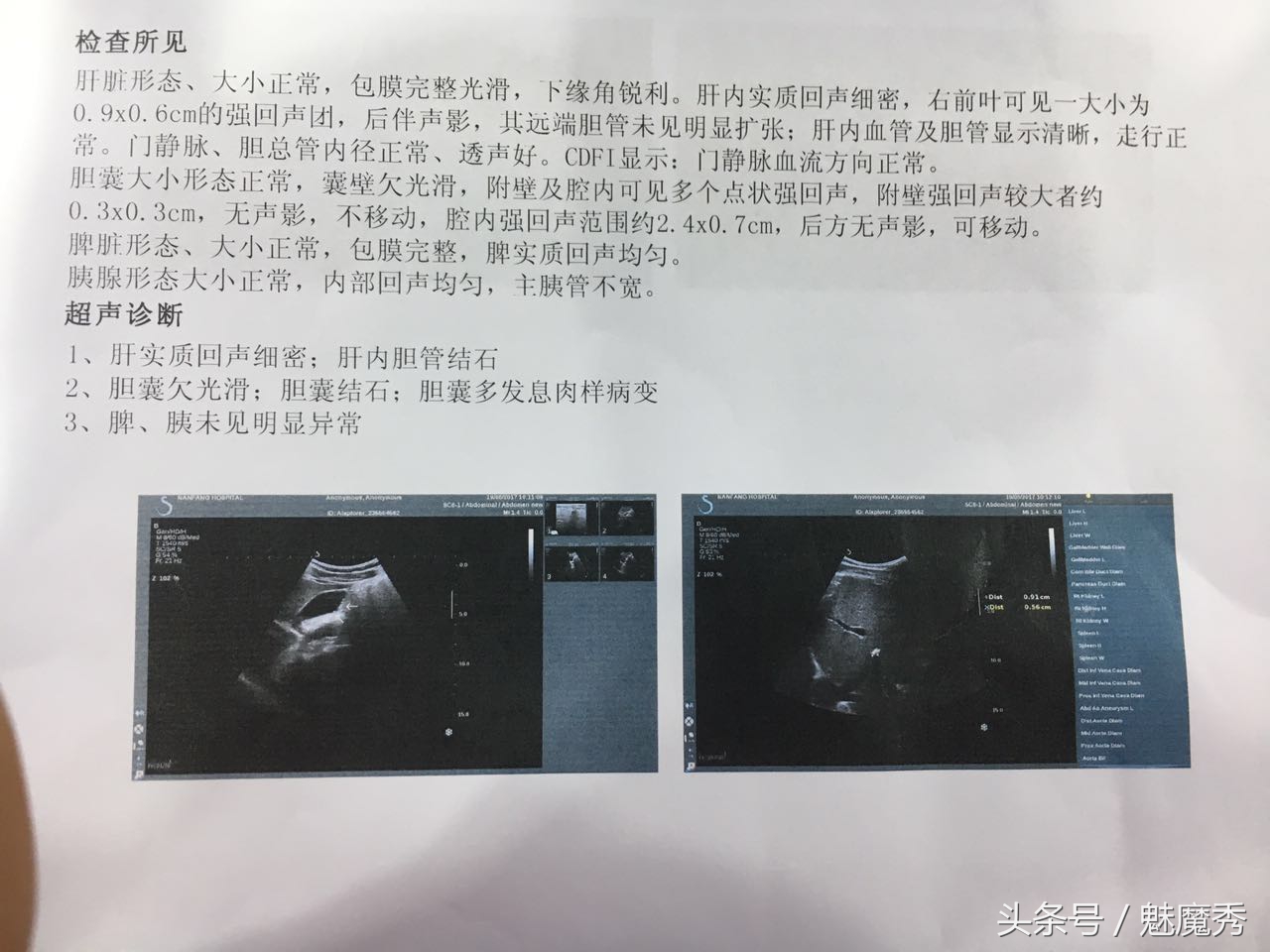 肝内胆管结石到底有没有得治？一个18年肝胆结石的患者想跟大家说说他的抗石经历