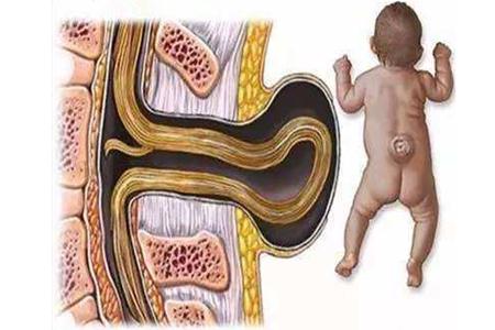 脊柱裂和脊柱有缝隙有什么区别,脊柱裂是骨骼病症吗