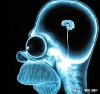 老人慢性硬膜下血肿严重吗,老年人慢性硬膜下血肿