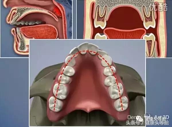 用嘴呼吸的对容貌的影响,用嘴呼吸会导致什么面容