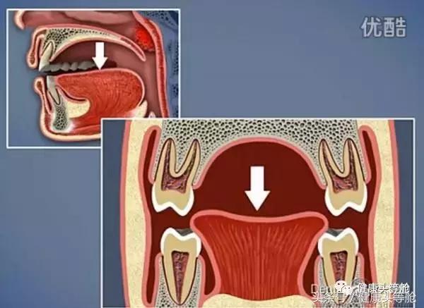 用嘴呼吸的对容貌的影响,用嘴呼吸会导致什么面容