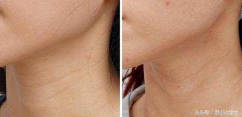 颈纹很深怎么办医美,颈纹很深怎么办