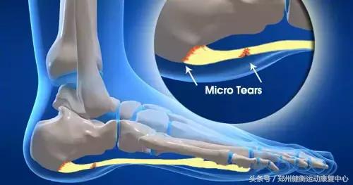 足底筋膜炎康复治疗,高足弓足底筋膜炎康复