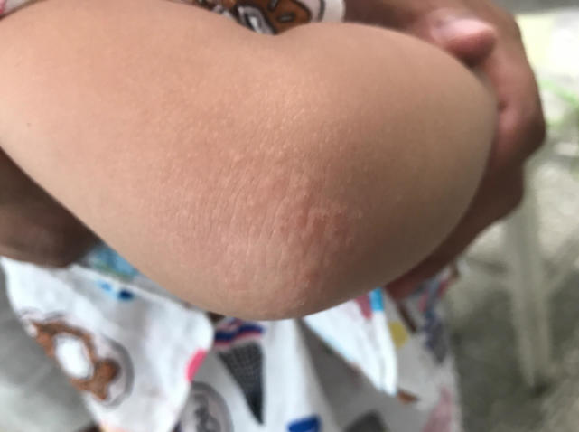 宝宝手背很多疹子,宝宝手背好多小包