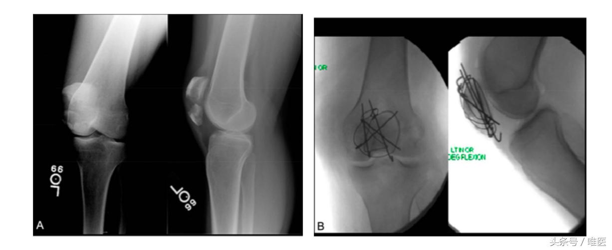 骨科前沿｜新式张力带固定术治疗复杂髌骨骨折，骨折骨性愈合率高达81.5%