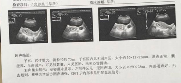 做阴式B超是一种什么经历？腹式B超和阴式B超的区别是什么？