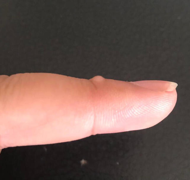 长在关节上的扁平的软软的疙瘩是啥病呢？