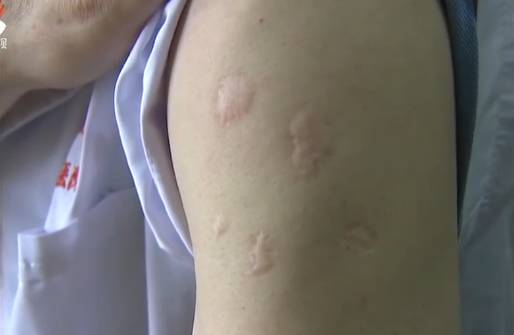 陈日新：持“灸”不息让中医再发力