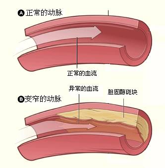 怎么让血管不长斑,消除血管斑的最佳方法