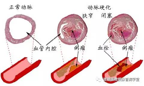 怎么让血管不长斑,消除血管斑的最佳方法