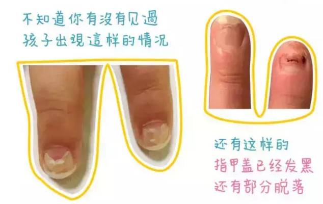 小孩手指甲断了可以重新长出来么,宝宝指甲断了要不要揭开断甲