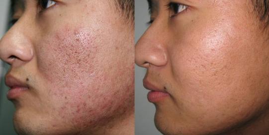 不神化的光子嫩肤，给皮肤反季节的吹弹可破！