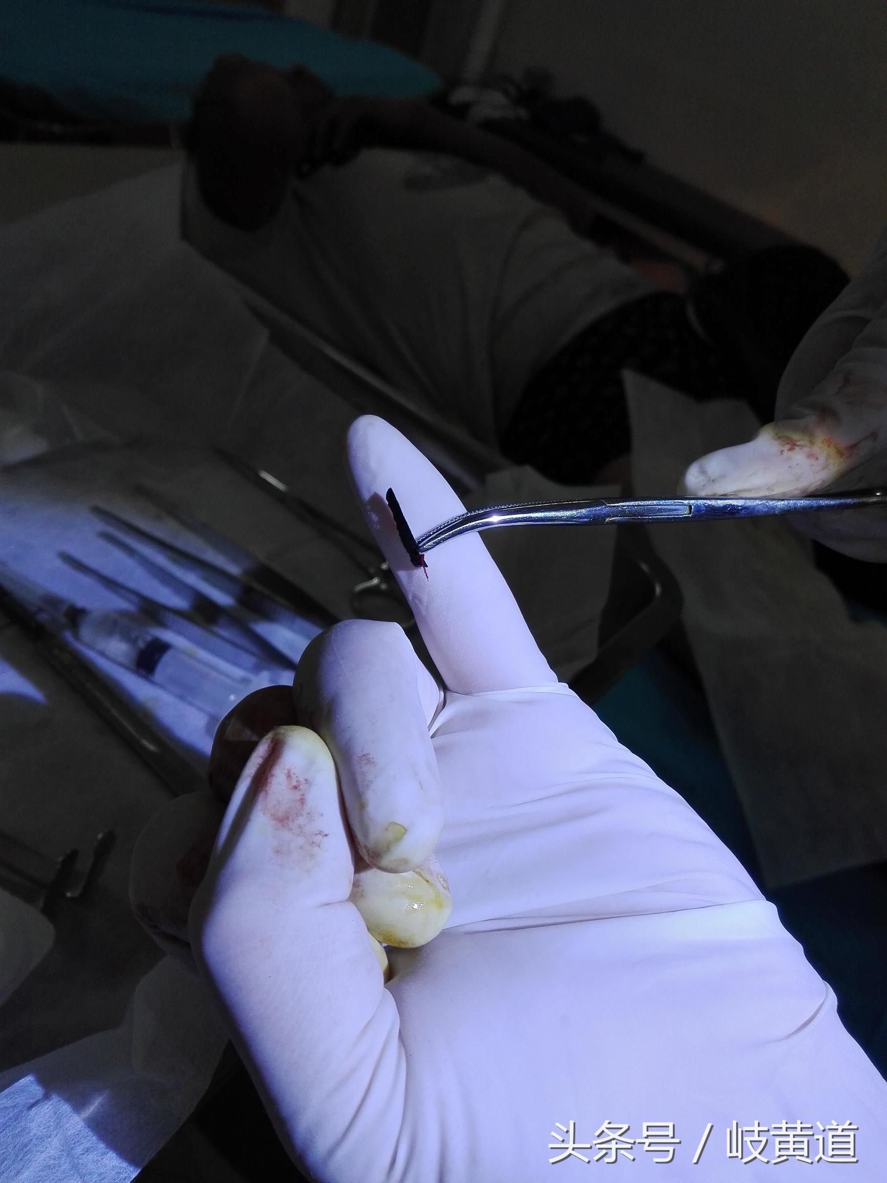 钢渣扎进男子大腿 医生手术2小时取出