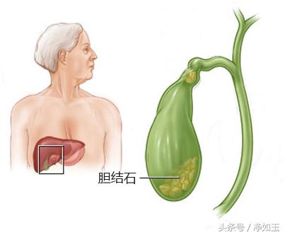 胆结石治疗方法和关注事项,胆结石正确治疗方法