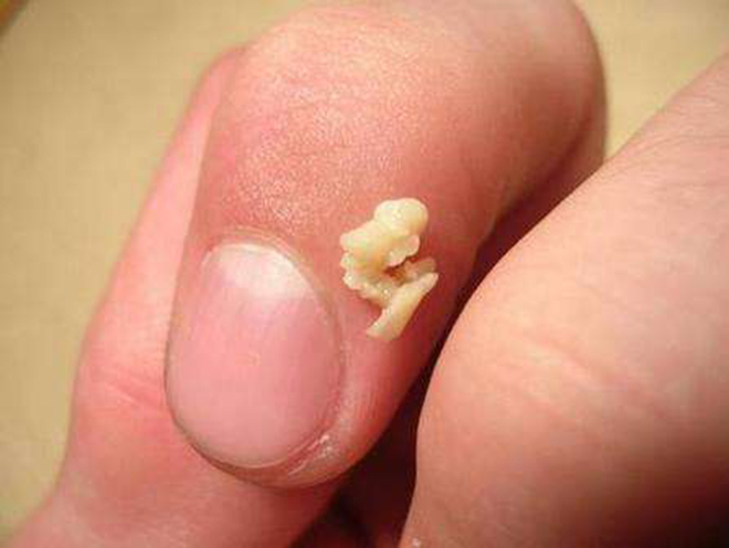 咳嗽咳出一粒白白的东西，以为是未吞下的米，拿起来一看吐了