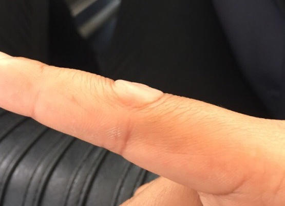 长在关节上的扁平的软软的疙瘩是啥病呢？