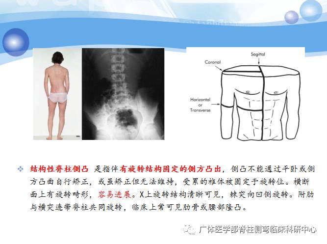 脊柱侧弯暑期训练营招募,脊柱侧弯夏令营视频