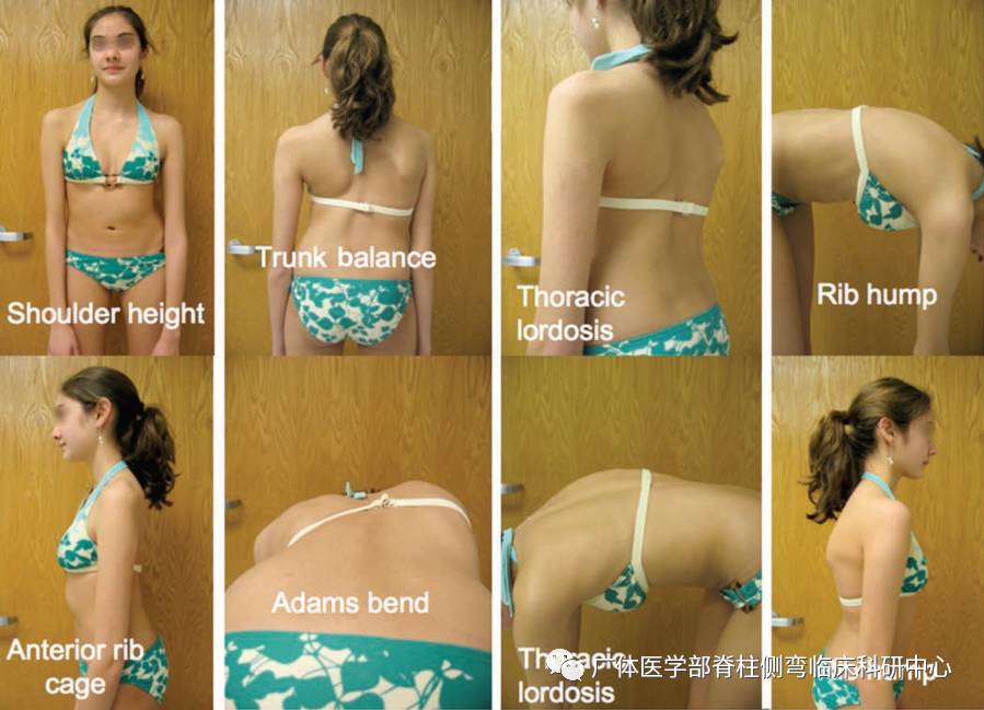 脊柱侧弯暑期训练营招募,脊柱侧弯夏令营视频