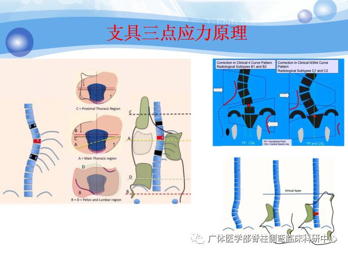 脊柱侧弯暑期训练营招募,脊柱侧弯夏令营视频