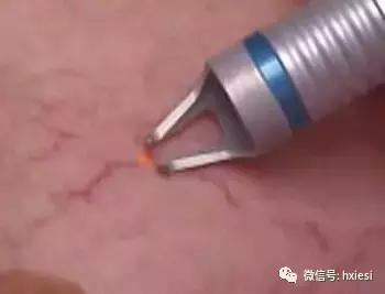 激光去除红脸蛋看过再决定