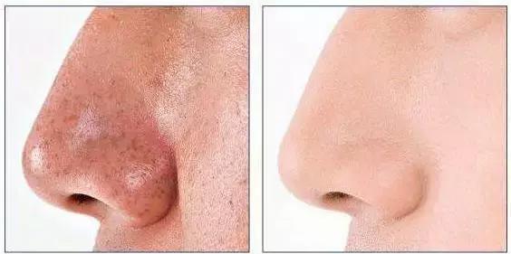 祛除黑头粉刺痘痘螨虫收缩毛孔,鼻子黑头多脸上毛孔大是螨虫