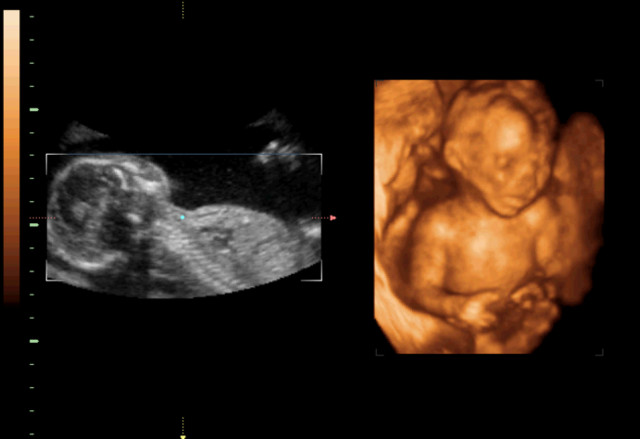 唇腭裂和兔唇四维提示什么,b超显示胎儿偏大一周会提前生吗