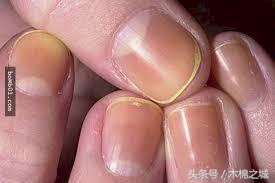 宝宝指甲颜色看起来不均匀,宝宝指甲发黄是什么前兆
