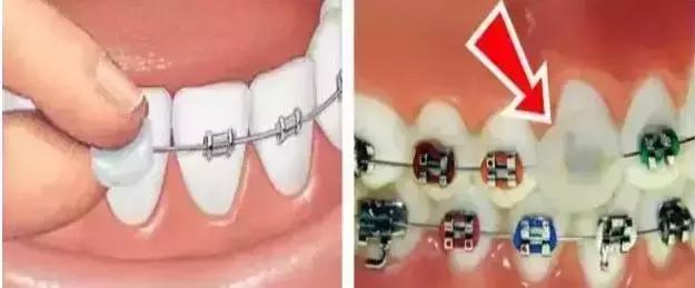 正畸戴牙环疼怎么办,正畸牙套戴不上了怎么办