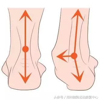 足底筋膜炎康复治疗,高足弓足底筋膜炎康复