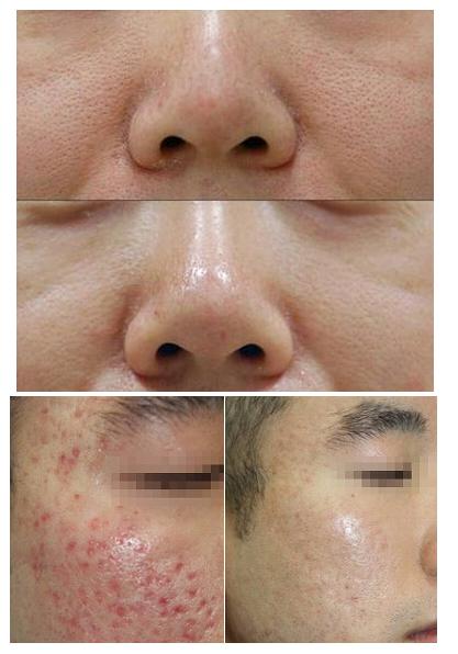 不神化的光子嫩肤，给皮肤反季节的吹弹可破！