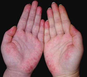 肺出血肾炎综合征是由什么导致的,肺出血肾炎综合症能治愈吗